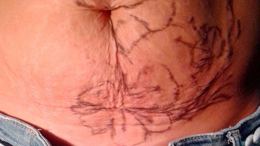 Dermatología descarta que la tinta de los tatuajes provoque cáncer de piel